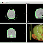 DICOM scan from Invesalius, showing the skull defect.