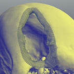 Refined inner lip of the skull's defect.