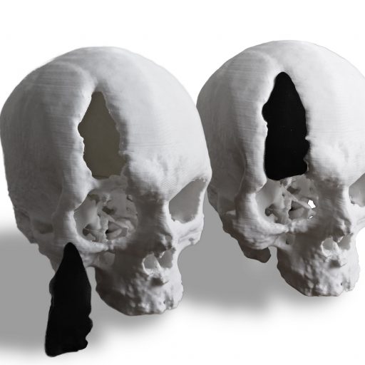 3D Prints of the skull and its implant.