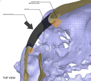 Undercuts in the skull.